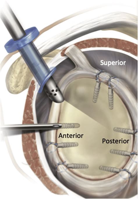 superior labrum tear orthopedic test|labral tear shoulder after surgery.